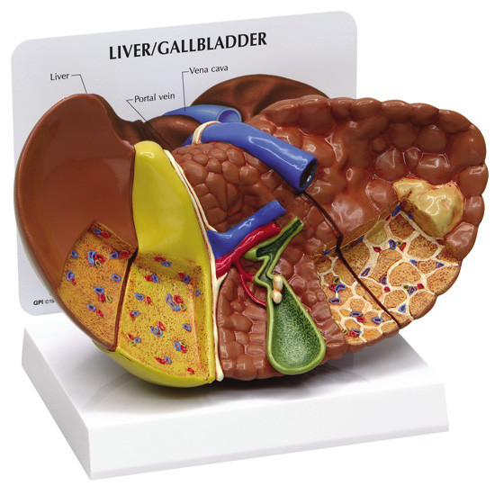 Maqueta de Higado con Cáncer/ Nasco Galloway Plastics SB46336
